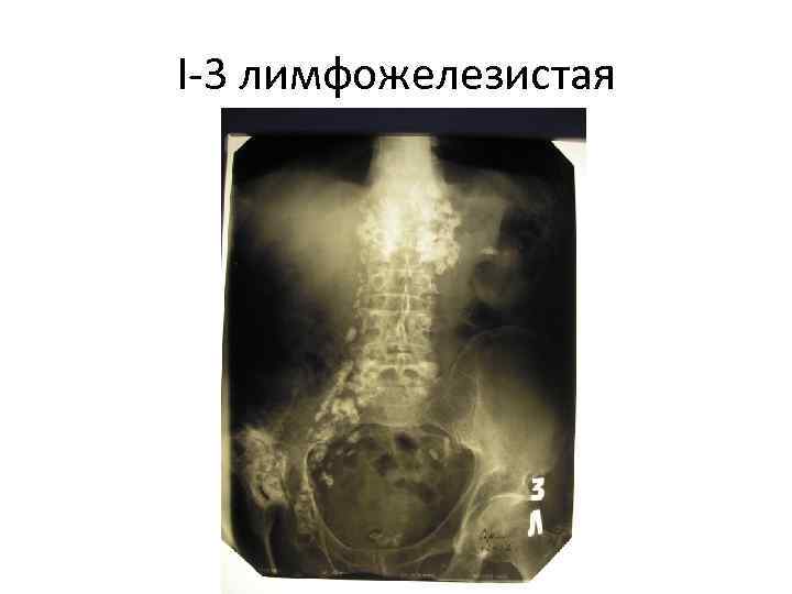 I-3 лимфожелезистая 