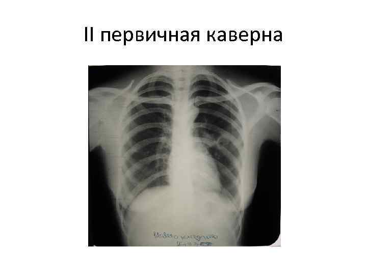 II первичная каверна 