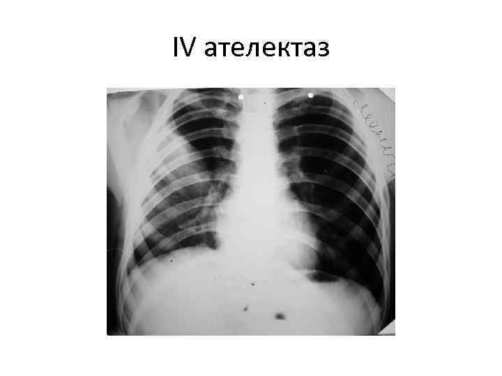 IV ателектаз 