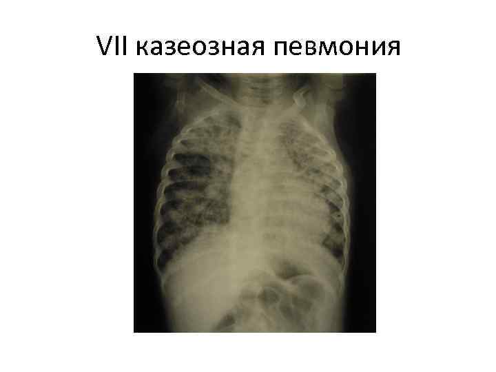 VII казеозная певмония 