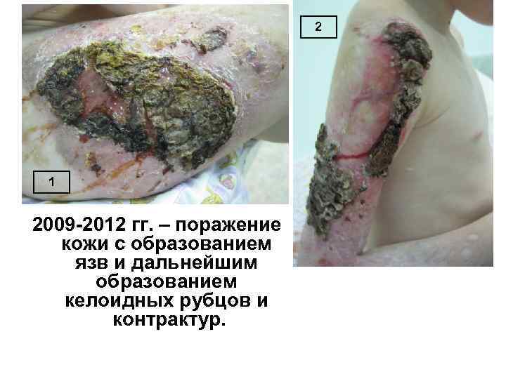 2 1 2009 -2012 гг. – поражение кожи с образованием язв и дальнейшим образованием