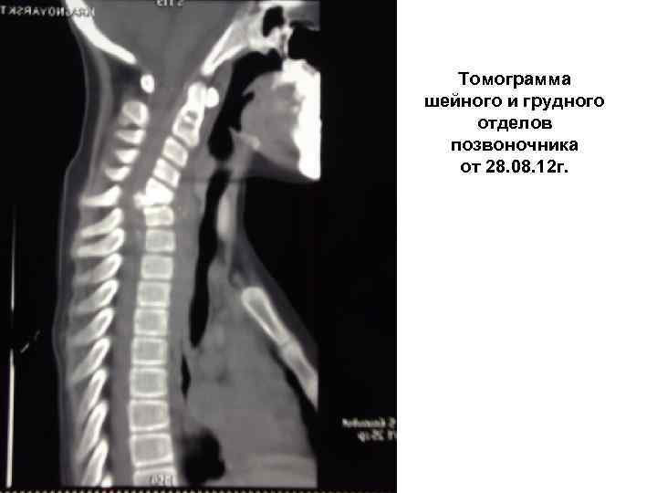 Томограмма шейного и грудного отделов позвоночника от 28. 08. 12 г. 