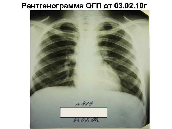Рентгенограмма ОГП от 03. 02. 10 г. 