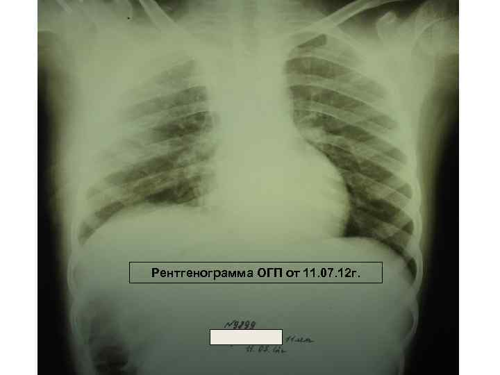 Рентгенограмма ОГП от 11. 07. 12 г. 