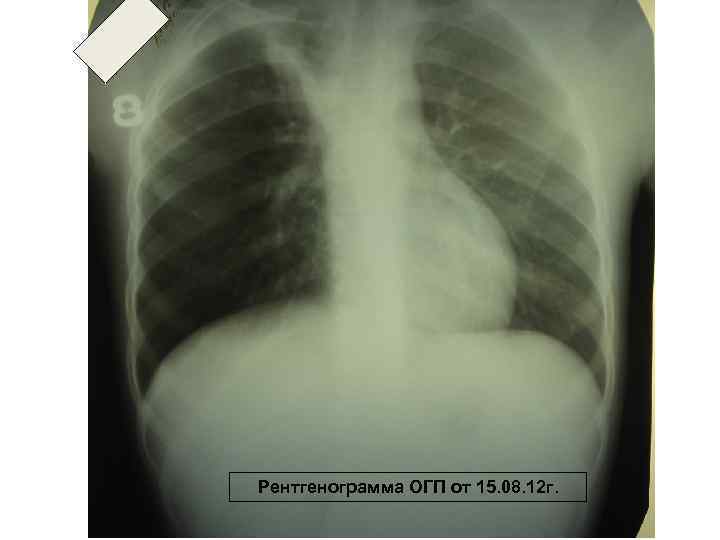 Рентгенограмма ОГП от 15. 08. 12 г. 