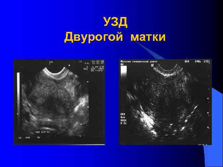 УЗД Двурогой матки 