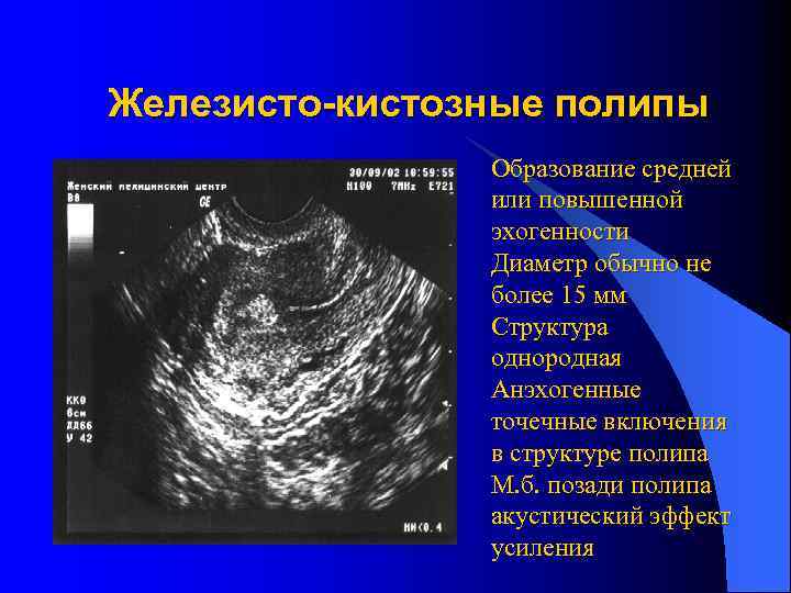 Полость матки неоднородная. Железисто-фиброзный эндометриальный полип. Аденоматозные полип эндометрия УЗИ. Железистый полип эндометрия на УЗИ.