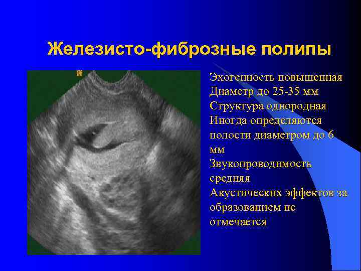 Железисто-фиброзные полипы Эхогенность повышенная Диаметр до 25 -35 мм Структура однородная Иногда определяются полости