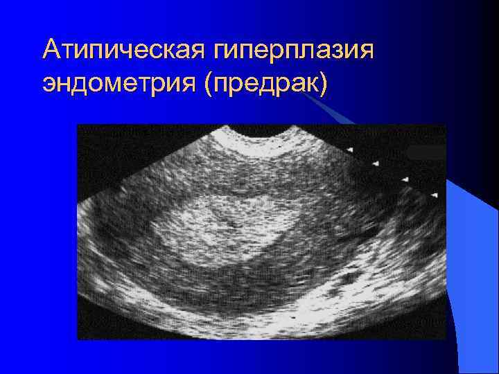 Предрак эндометрия. Железистая гиперплазия эндометрия УЗИ. Атипическая гиперплазия эндометрия УЗИ. Железистая атипическая гиперплазия. Атипическая гиперплазия эндометрия гистероскопия.