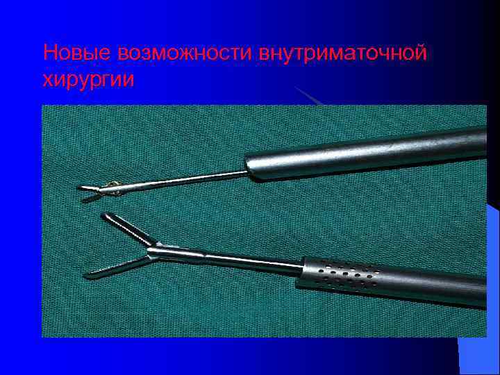 Новые возможности внутриматочной хирургии 