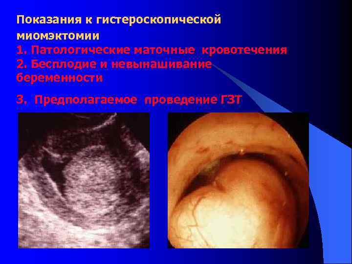Показания к гистероскопической миомэктомии 1. Патологические маточные кровотечения 2. Бесплодие и невынашивание беременности 3.