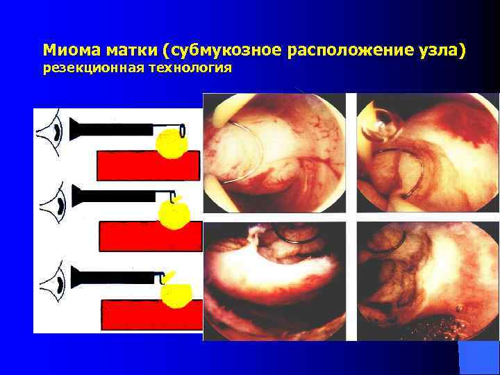 Миома матки (субмукозное расположение узла) резекционная технология 