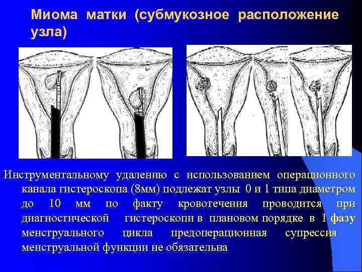 Миома матки (субмукозное расположение узла) Инструментальному удалению с использованием операционного канала гистероскопа (8 мм)