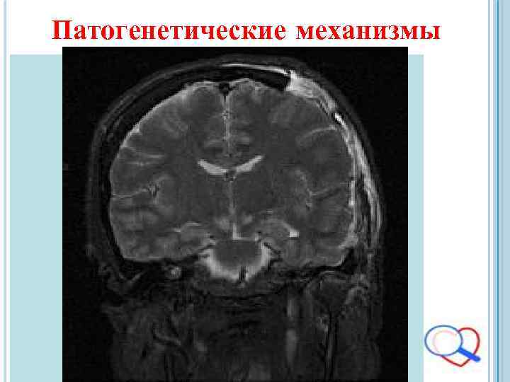 Патогенетические механизмы 