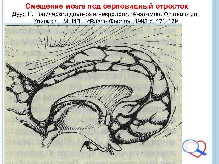  Смещение мозга под серповидный отросток Дуус П. Топический диагноз в неврологии Анатомия. Физиология.