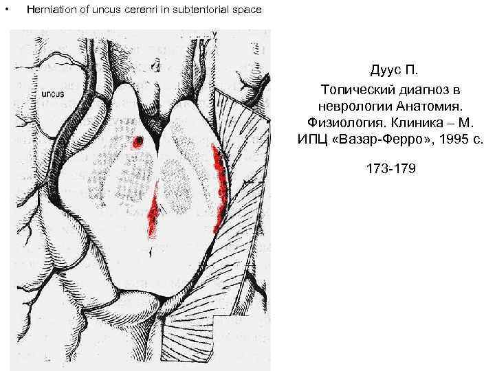  • Herniation of uncus cerenri in subtentorial space Дуус П. Топический диагноз в