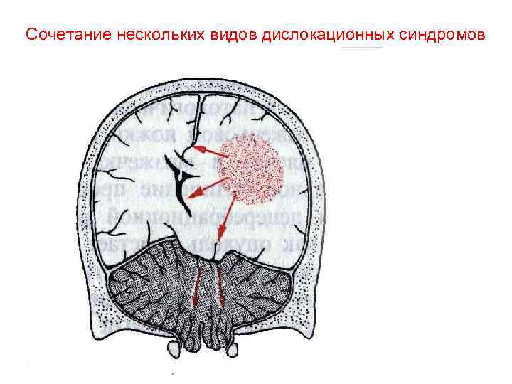 Сочетание нескольких видов дислокационных синдромов 