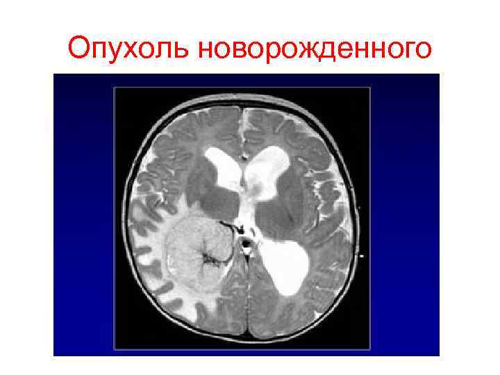 Опухоль новорожденного 