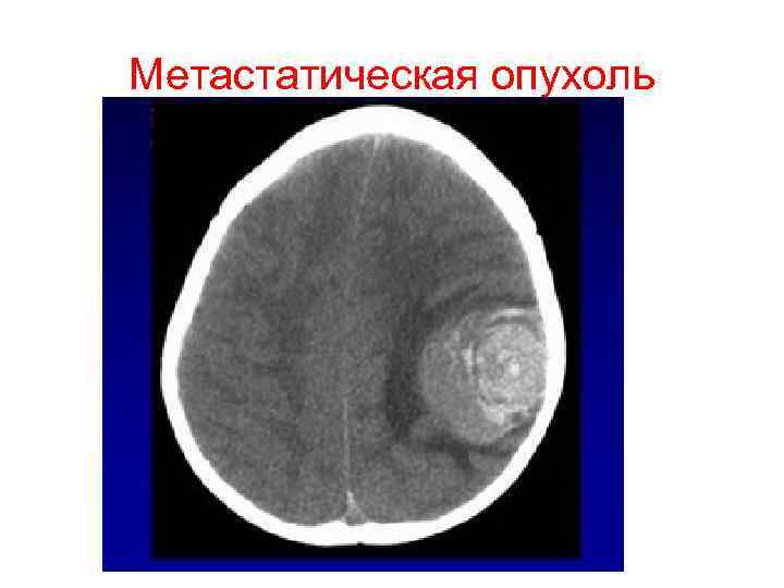 Метастатическая опухоль 