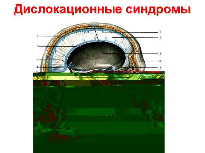 Дислокационные синдромы 