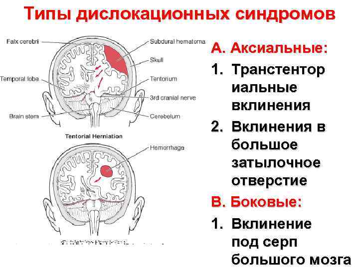 Синдром головного мозга. Дислокационный синдром неврология клиника. Дислокационные мозговые синдромы клиническая характеристика. Аксиальный дислокационный синдром. Аксиальная дислокация мозга.