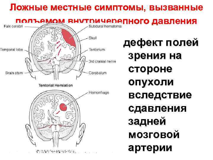 Ложные местные симптомы, вызванные подъемом внутричерепного давления дефект полей зрения на стороне опухоли вследствие