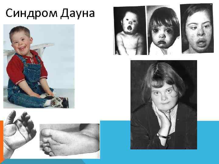 Синдром Дауна 