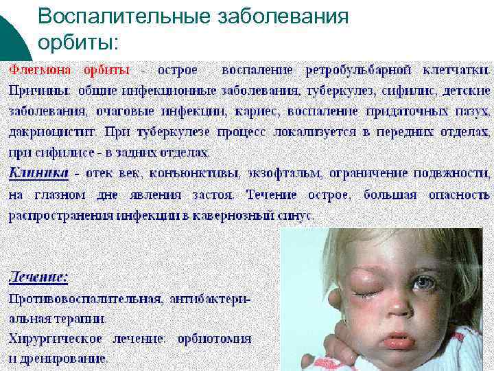Воспалительные заболевания орбиты: 