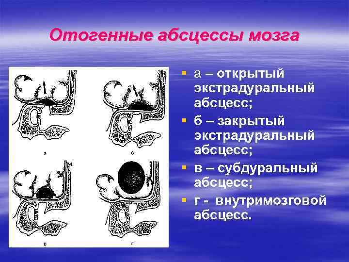 Отогенные абсцессы мозга § а – открытый экстрадуральный абсцесс; § б – закрытый экстрадуральный