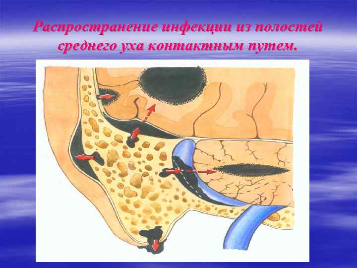 Распространение инфекции из полостей среднего уха контактным путем. 