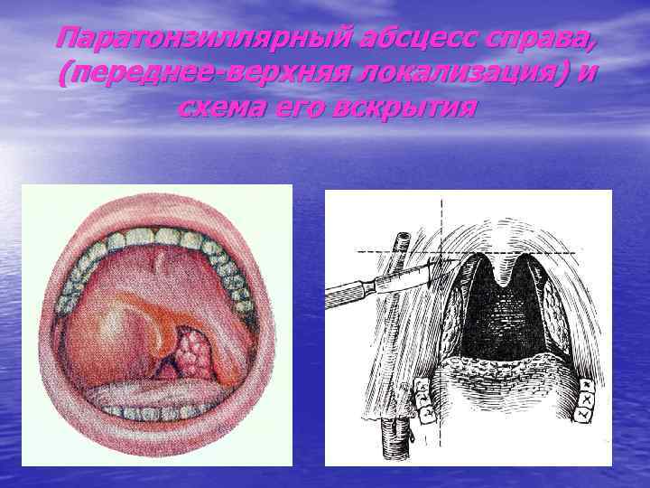 Паратонзиллярный абсцесс локальный статус карта вызова смп