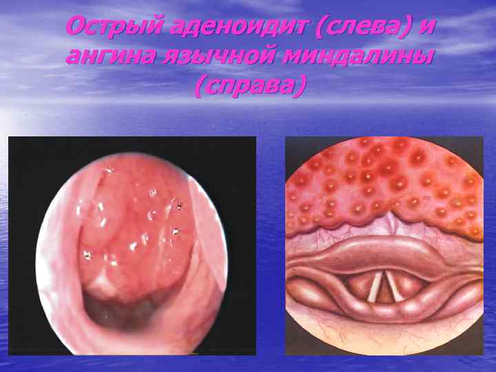 Острый аденоидит (слева) и ангина язычной миндалины (справа) 