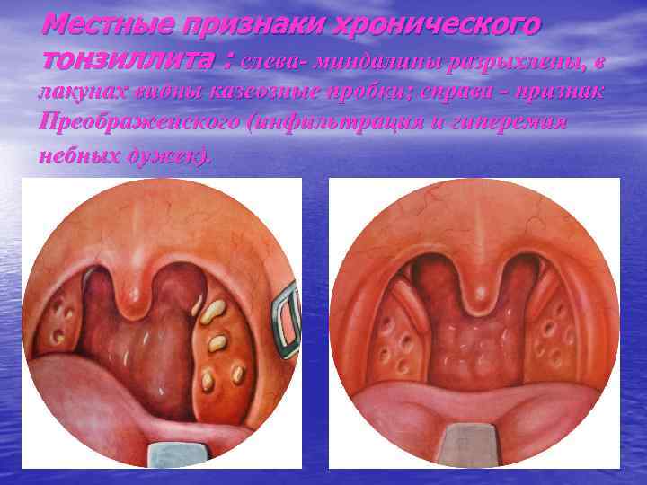 Местные признаки хронического тонзиллита : слева- миндалины разрыхлены, в лакунах видны казеозные пробки; справа