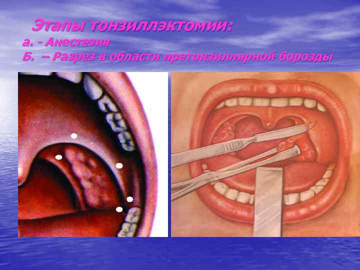 Этапы тонзиллэктомии: а. - Анестезия Б. – Разрез в области претонзиллярной борозды 