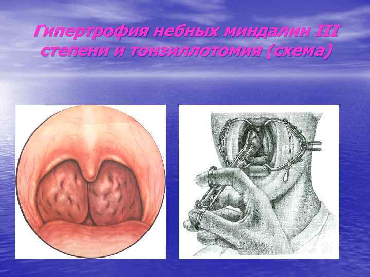 Гипертрофия небных миндалин III степени и тонзиллотомия (схема) 