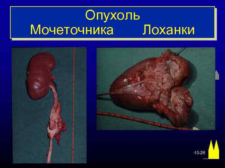 Опухоль Мочеточника Лоханки 10 -26 