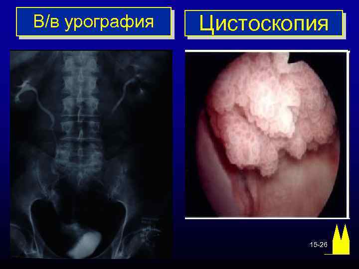 В/в урография Цистоскопия 15 -26 