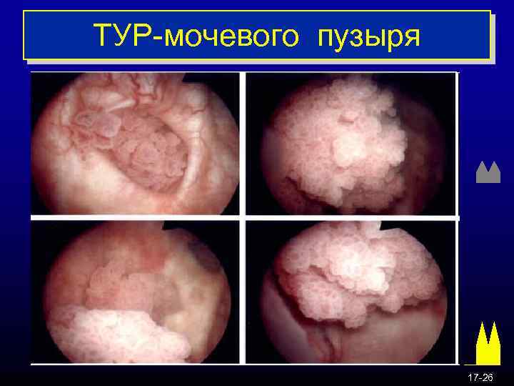 TУР-мочевого пузыря 17 -26 