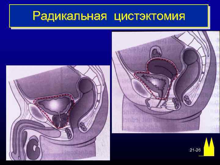 Радикальная цистэктомия 21 -26 