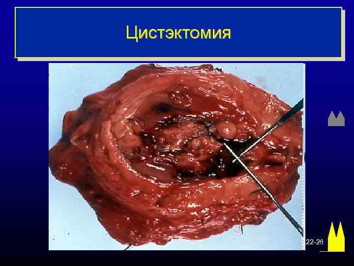 Цистэктомия 22 -26 