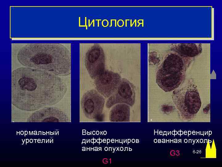 Цитология нормальный уротелий Высоко дифференциров анная опухоль G 1 Недифференцир ованная опухоль G 3