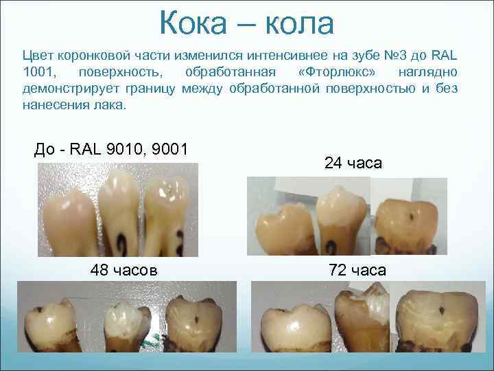 Кока – кола Цвет коронковой части изменился интенсивнее на зубе № 3 до RAL