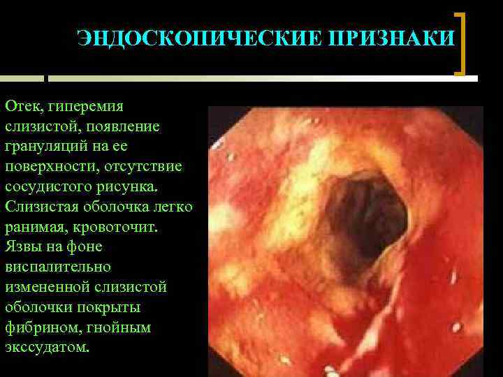 ЭНДОСКОПИЧЕСКИЕ ПРИЗНАКИ Отек, гиперемия слизистой, появление грануляций на ее поверхности, отсутствие сосудистого рисунка. Слизистая
