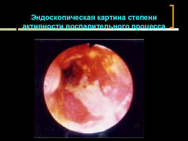 Эндоскопическая картина степени активности воспалительного процесса 