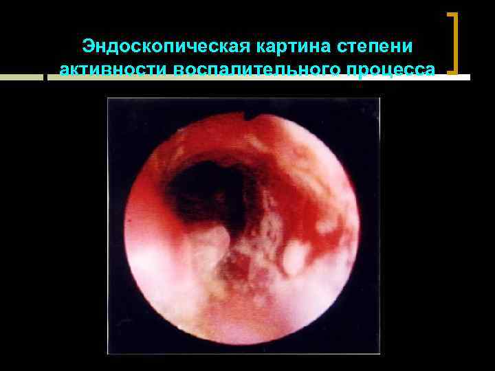 Эндоскопическая картина степени активности воспалительного процесса 
