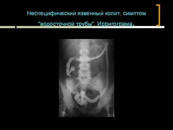 Неспецифический язвенный колит, симптом 