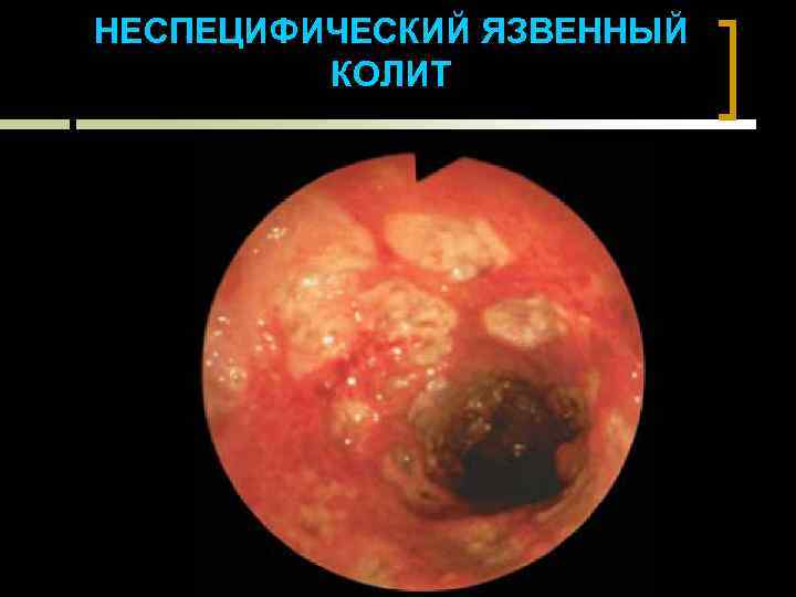 НЕСПЕЦИФИЧЕСКИЙ ЯЗВЕННЫЙ КОЛИТ 