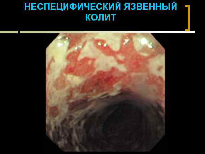 НЕСПЕЦИФИЧЕСКИЙ ЯЗВЕННЫЙ КОЛИТ 
