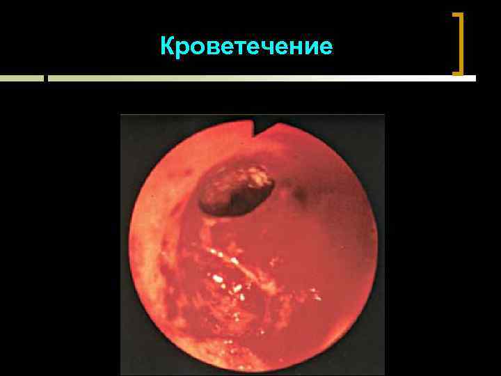 Кроветечение 