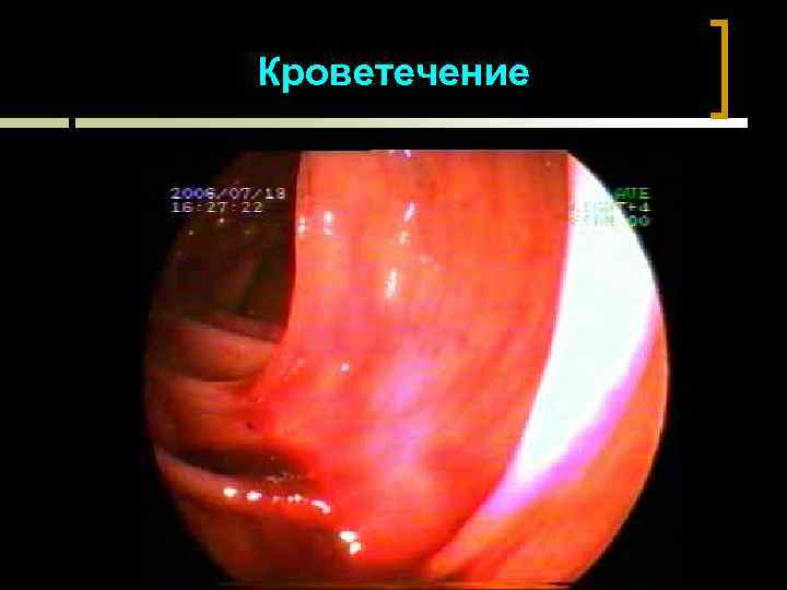 Кроветечение 